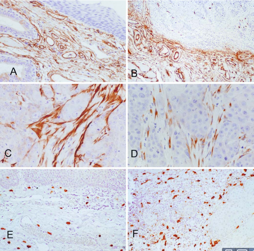 hnsccstroma