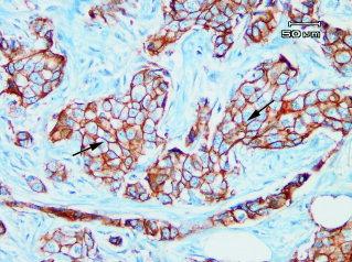 Gupta, 2003. High-magnification photomicrograph of a high-grade ductal carcinoma. Note the diffuse uniform membranous E.cadherin staining (arrows) of the tumor cells.