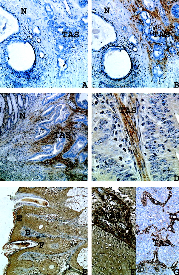 Wang-Rodriguez, 2002. PINCH protein is present in normal stroma in low abundance but is up-regulated in the stroma associated with common carcinomas.